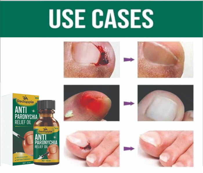 Anti Paronychia Relief Oil- Buy 1 Get 1 Free